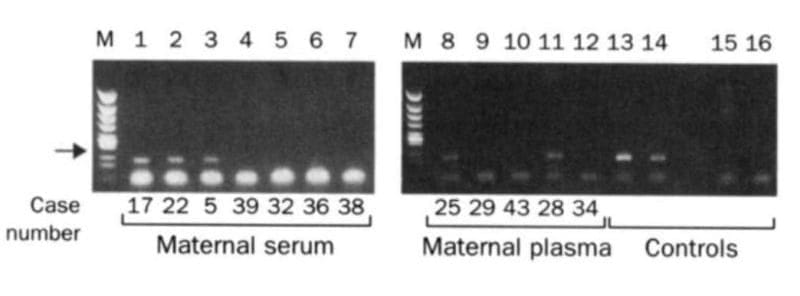 Circulating cell free DNA testing was born in 1997